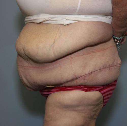 Tummy Tuck Before & After Gallery - Patient 58172337 - Image 4