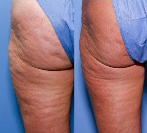 Cellulite Treatment Before & After Gallery - Patient 58172340 - Image 1
