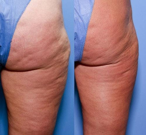 Cellulite Treatment Before & After Gallery - Patient 58172340 - Image 2