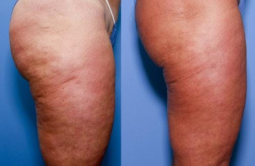 Cellulite Treatment Before & After Gallery - Patient 58172340 - Image 3