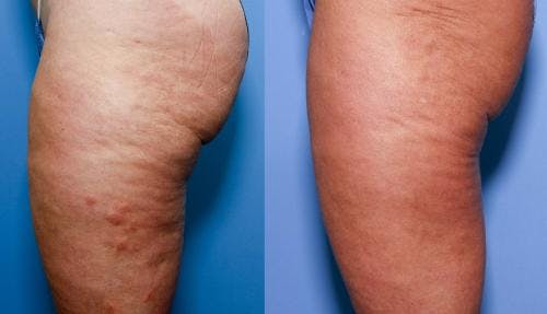 Cellulite Treatment Before & After Gallery - Patient 58172340 - Image 4