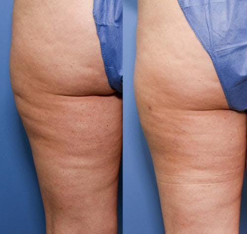 Cellulite Treatment Before & After Gallery - Patient 58172342 - Image 1