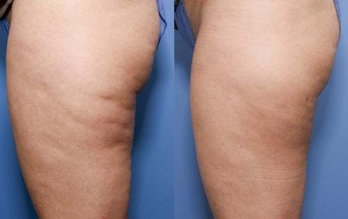 Cellulite Treatment Before & After Gallery - Patient 58172342 - Image 2