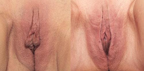 Labiaplasty Before & After Gallery - Patient 58172343 - Image 1