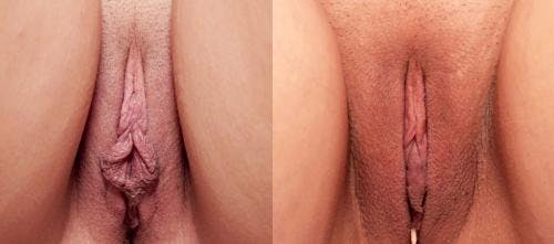 Labiaplasty Before & After Gallery - Patient 58172344 - Image 1