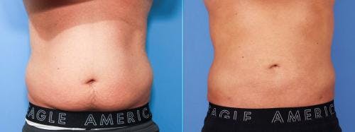 Abdomen Before & After Gallery - Patient 149385214 - Image 1