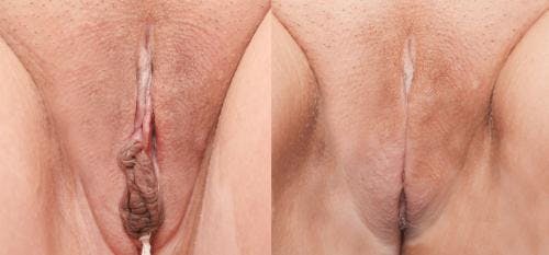 Labiaplasty Before & After Gallery - Patient 58172346 - Image 1