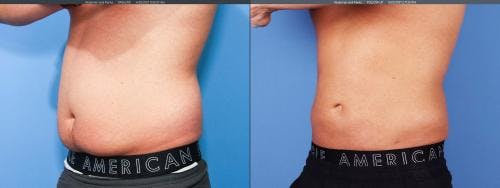 Abdomen Before & After Gallery - Patient 149385214 - Image 2