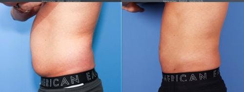 Abdomen Before & After Gallery - Patient 149385214 - Image 3