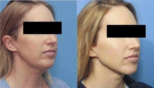 Face Before & After Gallery - Patient 149385111 - Image 2