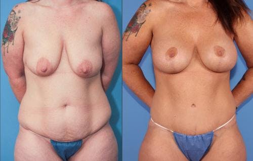 Mommy Makeover Before & After Gallery - Patient 58172353 - Image 1