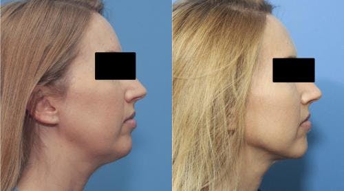 Face Before & After Gallery - Patient 149385111 - Image 3