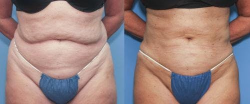 Abdomen Before & After Gallery - Patient 149385216 - Image 1