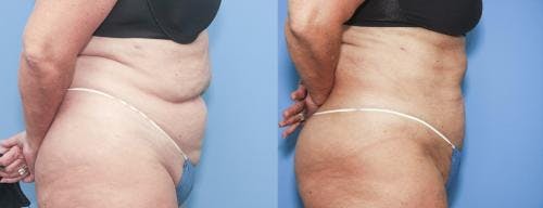 Abdomen Before & After Gallery - Patient 149385216 - Image 2