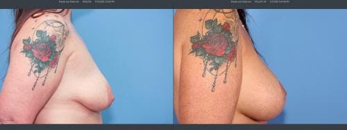 Mommy Makeover Before & After Gallery - Patient 58172353 - Image 6