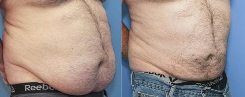 Abdomen Before & After Gallery - Patient 149385229 - Image 2