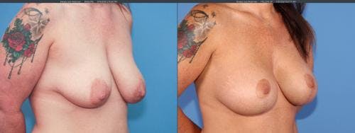 Mommy Makeover Before & After Gallery - Patient 58172353 - Image 7