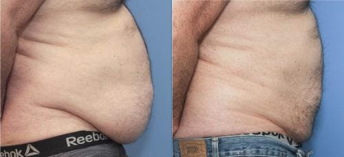 Abdomen Before & After Gallery - Patient 149385229 - Image 3