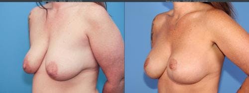Mommy Makeover Before & After Gallery - Patient 58172353 - Image 8