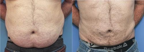 Abdomen Before & After Gallery - Patient 149385229 - Image 1