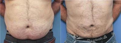 Abdomen Before & After Gallery - Patient 149385229 - Image 1