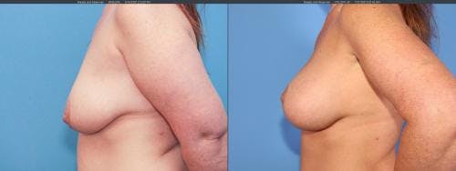 Mommy Makeover Before & After Gallery - Patient 58172353 - Image 9