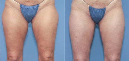 Thighs Before & After Gallery - Patient 149385421 - Image 1