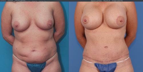 Mommy Makeover Before & After Gallery - Patient 58172355 - Image 1