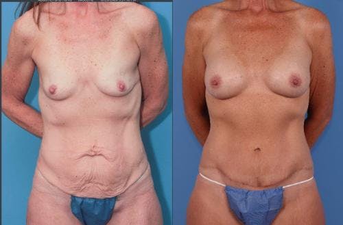 Mommy Makeover Before & After Gallery - Patient 58172357 - Image 1
