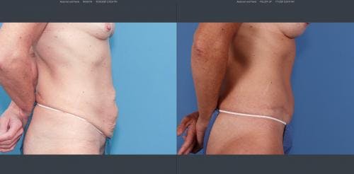 Mommy Makeover Before & After Gallery - Patient 58172357 - Image 3