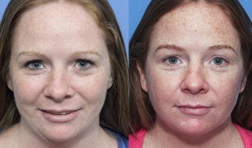 Face & Neck Before & After Gallery - Patient 149385110 - Image 1