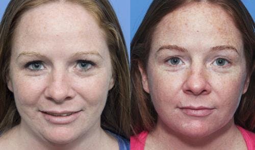 Liposuction Before & After Gallery - Patient 58172356 - Image 4