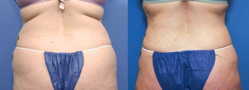 Hips Before & After Gallery - Patient 149385344 - Image 1