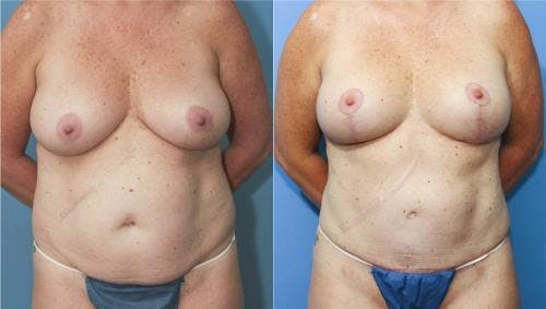 Mommy Makeover Before & After Gallery - Patient 58172358 - Image 1