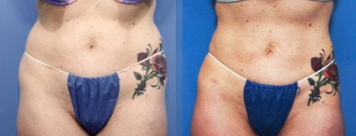 Hips Before & After Gallery - Patient 149385344 - Image 2