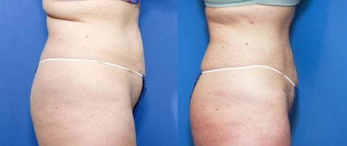 Hips Before & After Gallery - Patient 149385344 - Image 3