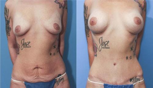 Mommy Makeover Before & After Gallery - Patient 58172360 - Image 1