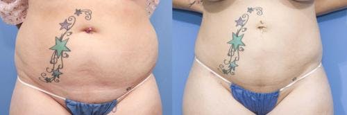 Abdomen Before & After Gallery - Patient 149385226 - Image 1