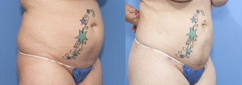 Abdomen Before & After Gallery - Patient 149385226 - Image 2