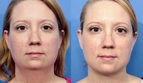 Face Before & After Gallery - Patient 149385112 - Image 1