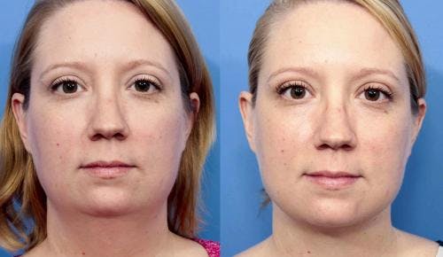 Face & Neck Before & After Gallery - Patient 149385112 - Image 1
