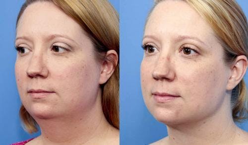 Face Before & After Gallery - Patient 149385112 - Image 2