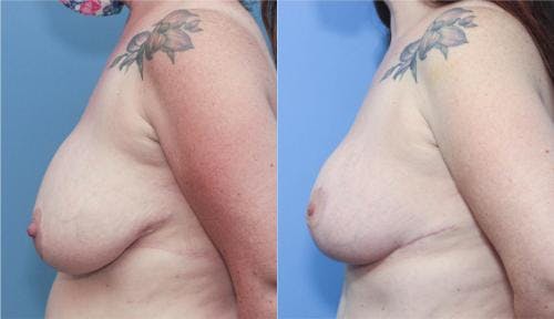 Mommy Makeover Before & After Gallery - Patient 58172368 - Image 5