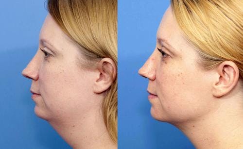Face Before & After Gallery - Patient 149385112 - Image 5