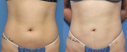 Abdomen Before & After Gallery - Patient 149385228 - Image 1