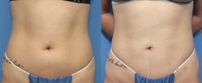 Abdomen Before & After Gallery - Patient 149385228 - Image 1