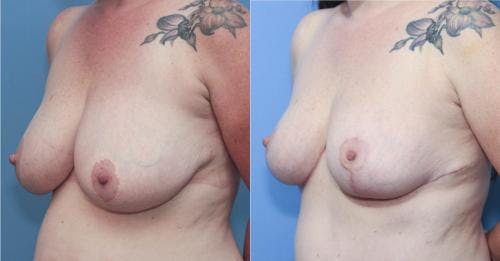 Mommy Makeover Gallery - Patient 58172374 - Image 2