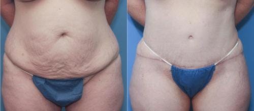Mommy Makeover Before & After Gallery - Patient 58172374 - Image 3