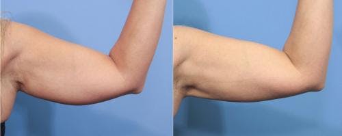 Arms Before & After Gallery - Patient 149385359 - Image 1