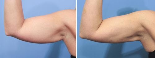 Arms Before & After Gallery - Patient 149385359 - Image 2